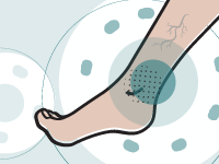 Couverture du guide de référence du patient pour Ulcères de jambe veineux